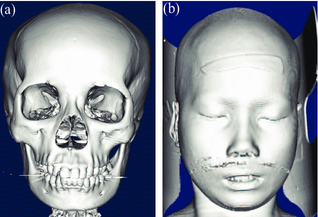 Example Of The Female Skull Model 3d Ct Scan Data And The Associated Facial