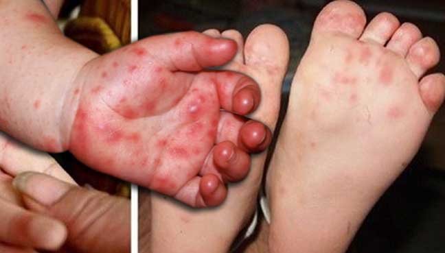Tangan Kaki Mulut